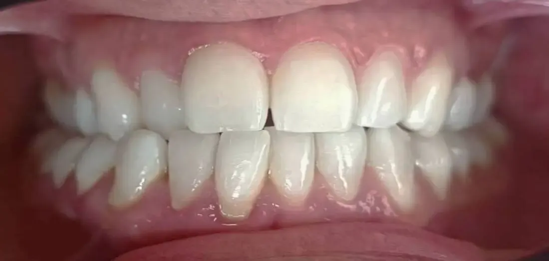Caso 1 antes del tratamiento: dientes desalineados